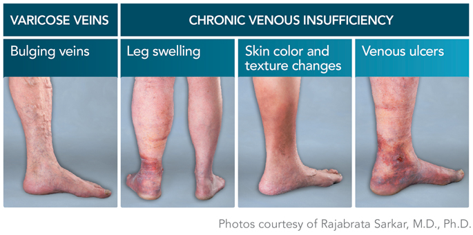 Chronic Venous Insufficiency - Ivein Clinic